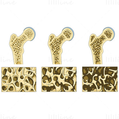 Osteoporose vector wetenschappelijke illustratie