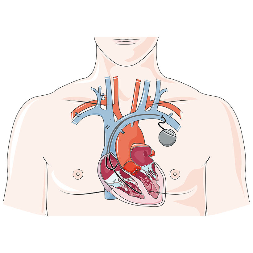 Pacemaker vector