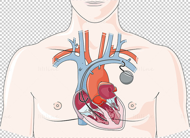 心脏起搏器矢量示意图