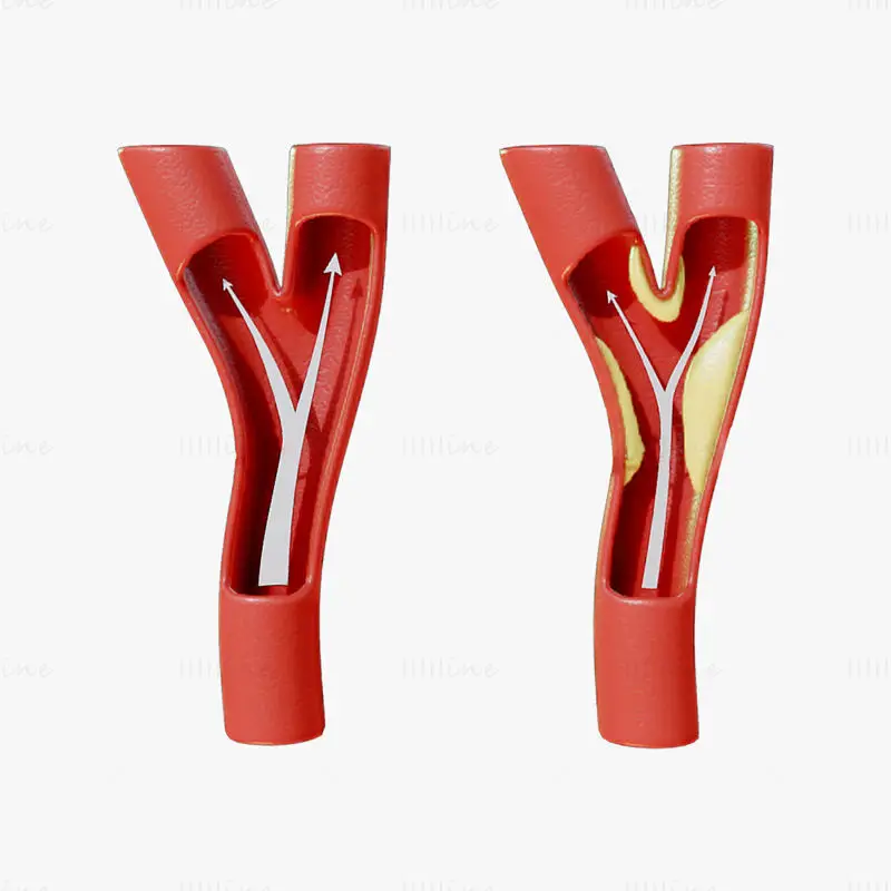 Peripheral artery disease medical illustration