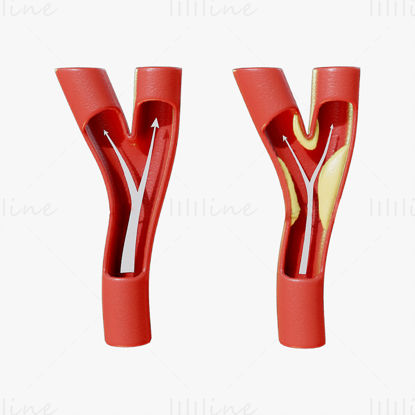 Peripheral Artery Disease Medical Science 3D Model