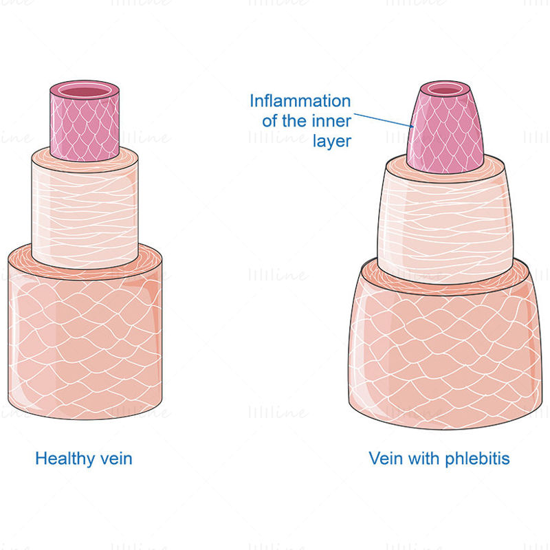 vector de flebitis