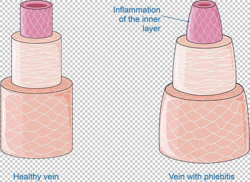 Phlebitis vector