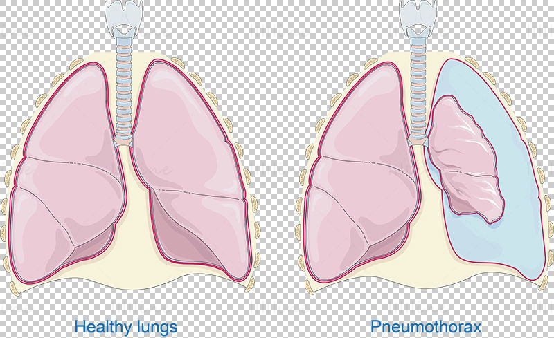 Pneumothorax vector
