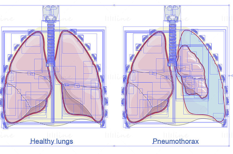 Pneumothorax vector
