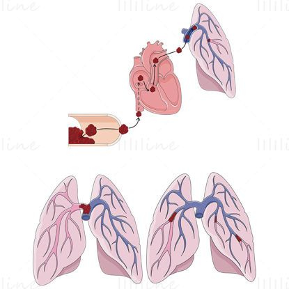 Pulmonary embolism vector