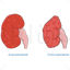 Pyelonephritis vector