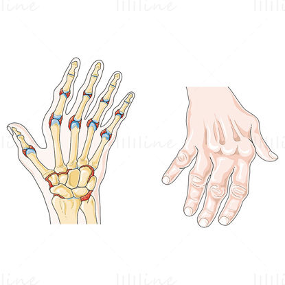 Wissenschaftliche Illustration des Vektors der rheumatoiden Arthritis