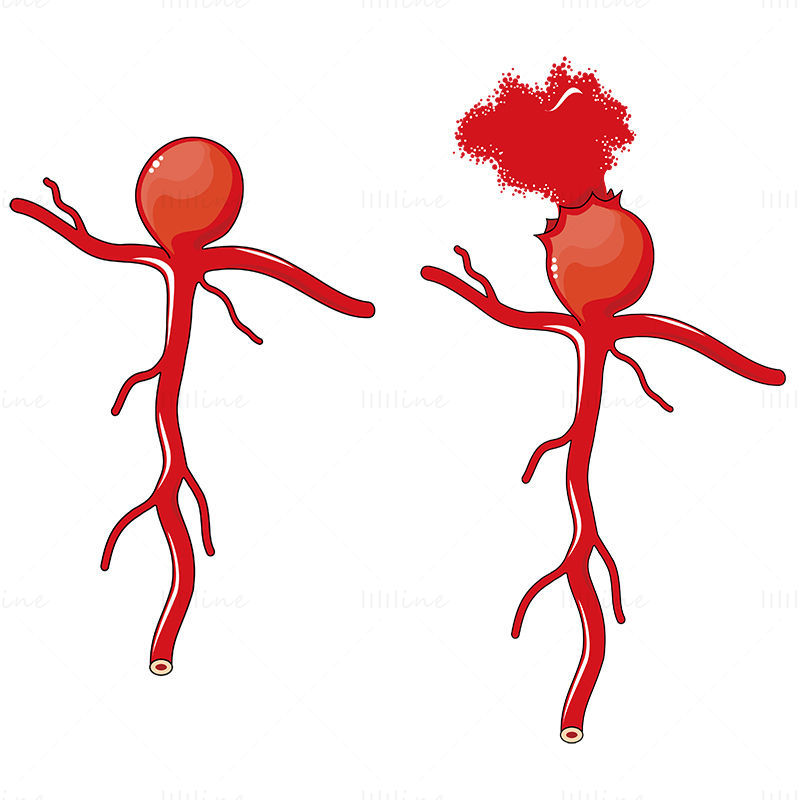 Saccular aneurysm vector scientific illustration