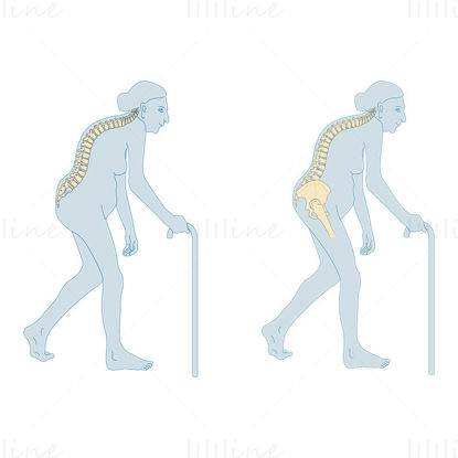 Severe osteoporosis vector scientific illustration