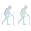 Severe osteoporosis vector scientific illustration