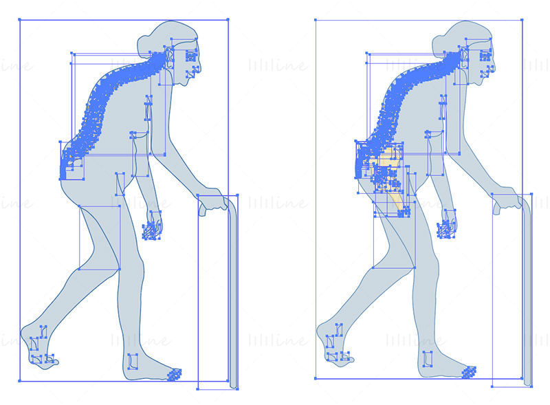 Severe osteoporosis vector scientific illustration