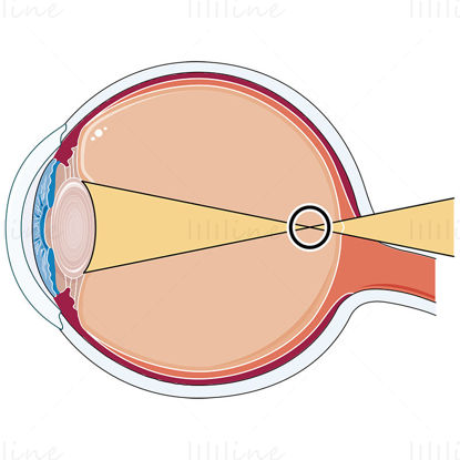 Shortsighted eye vector illustration, Ophtalmology