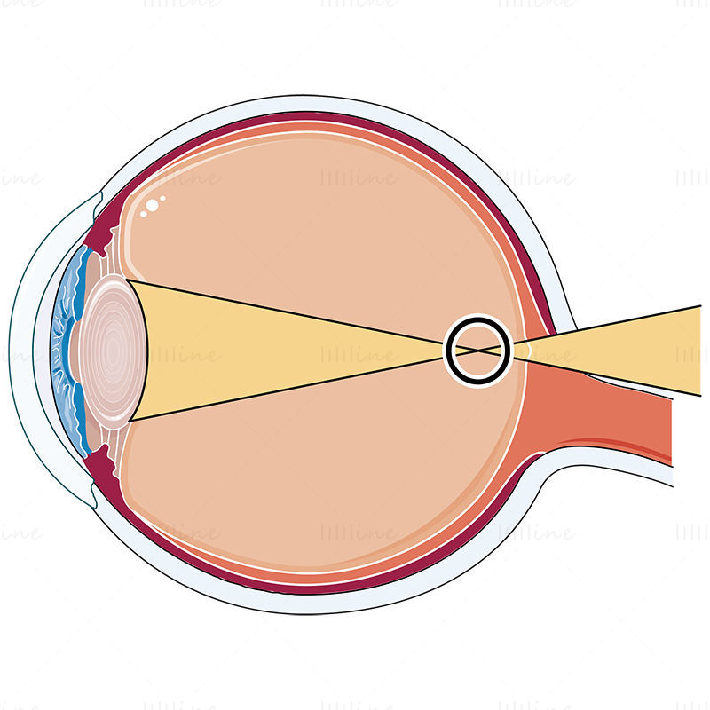 Ilustración de vector de ojo miope, Oftalmología