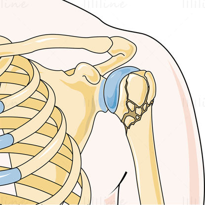 Shoulder fracture vector scientific illustration