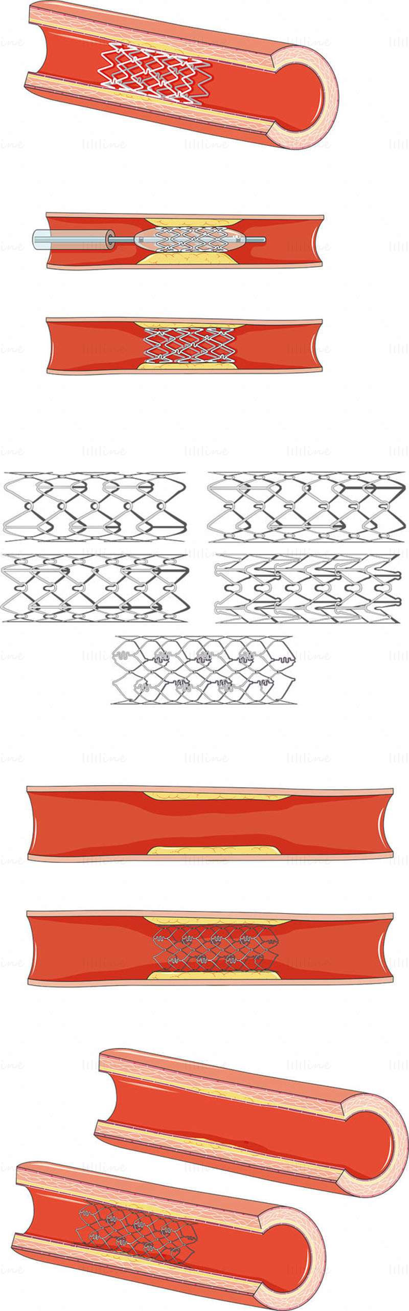 Ilustração científica vetorial de stent