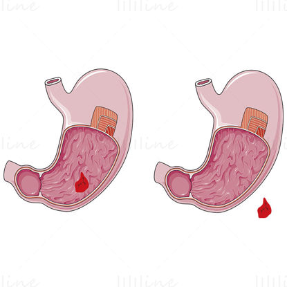Stomach ulcer vector