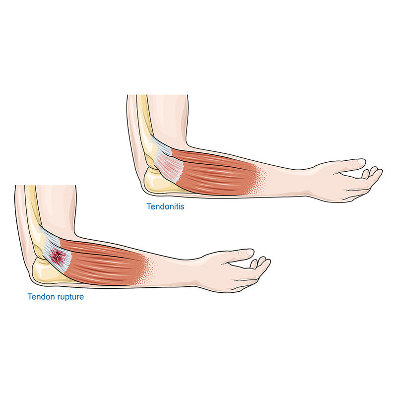 Tendonitis vector scientific illustration