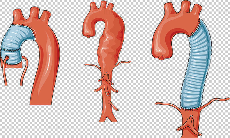 Thoracic aortic aneurysm vector scientific illustration