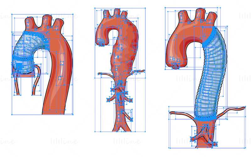 Ilustración científica del vector de aneurisma aórtico torácico