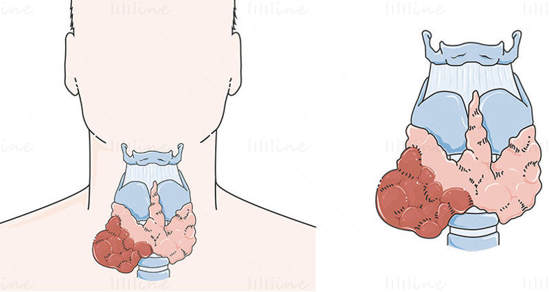 Thyroid cancer vector scientific illustration