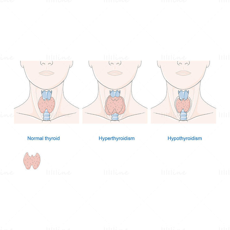Thyroid diseases vector