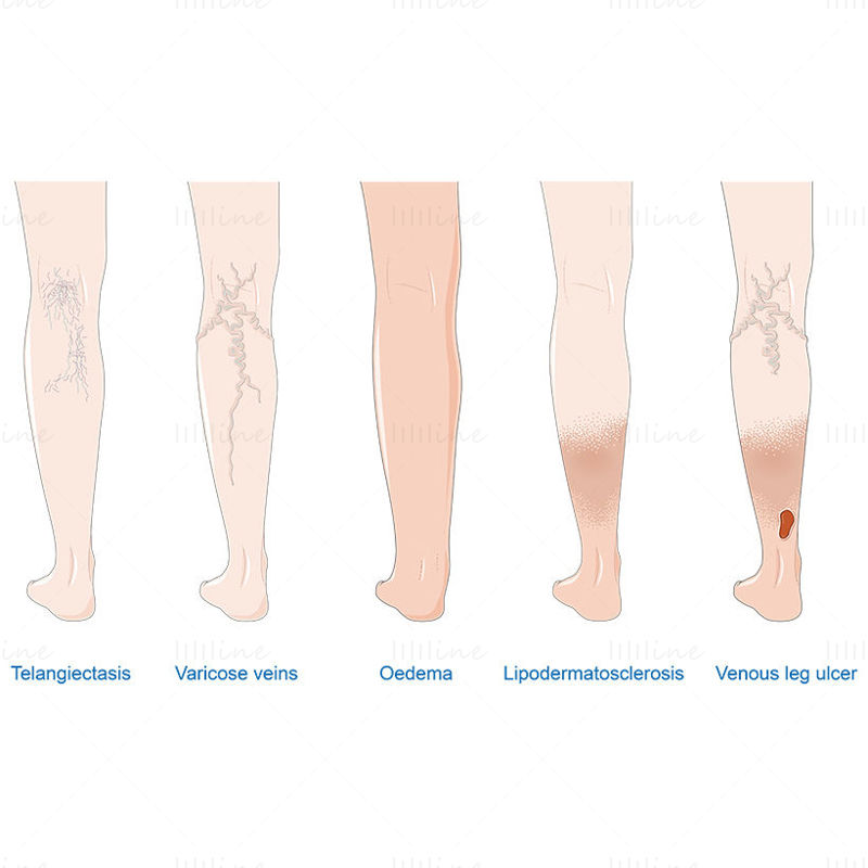 Venous disease vector