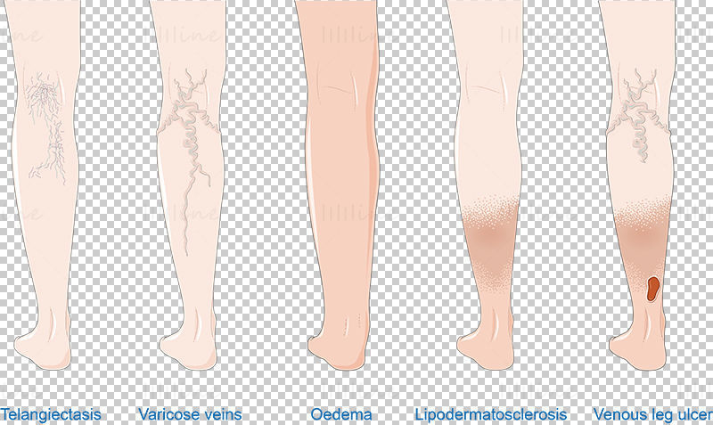 Venous disease vector