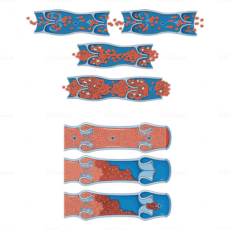 Venous thrombosis vector