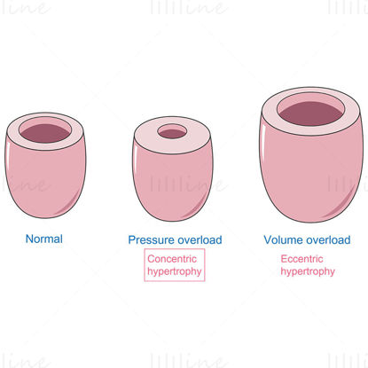 Ventricular hypertrophy vector