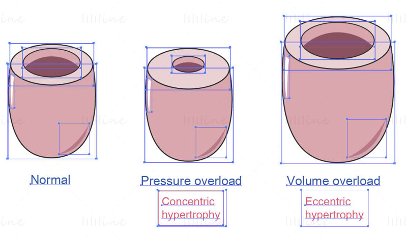 Ventricular hypertrophy vector