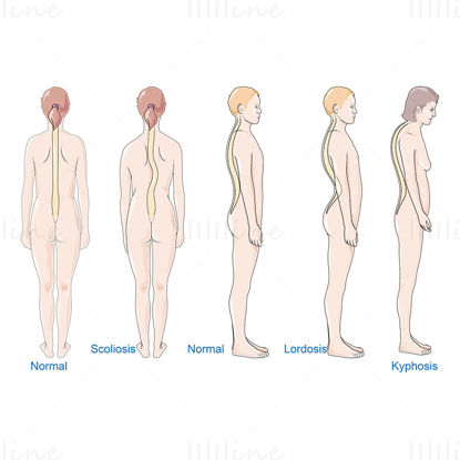 脊柱疾病矢量科学绘图插画