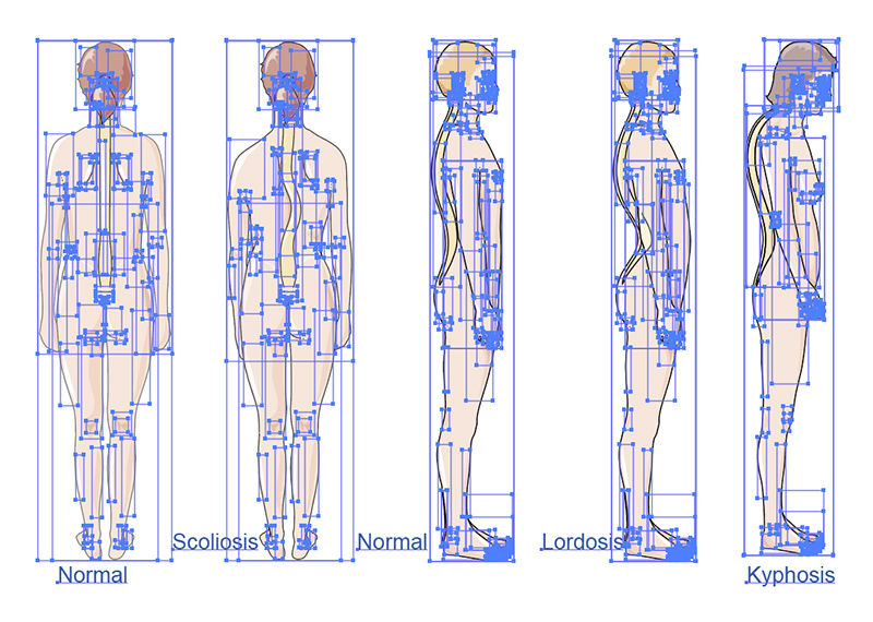 Vertebral column disorders vector scientific illustration